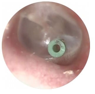 Image of grommet in ear canal